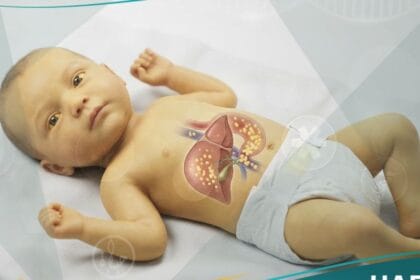 يرقان الرضع