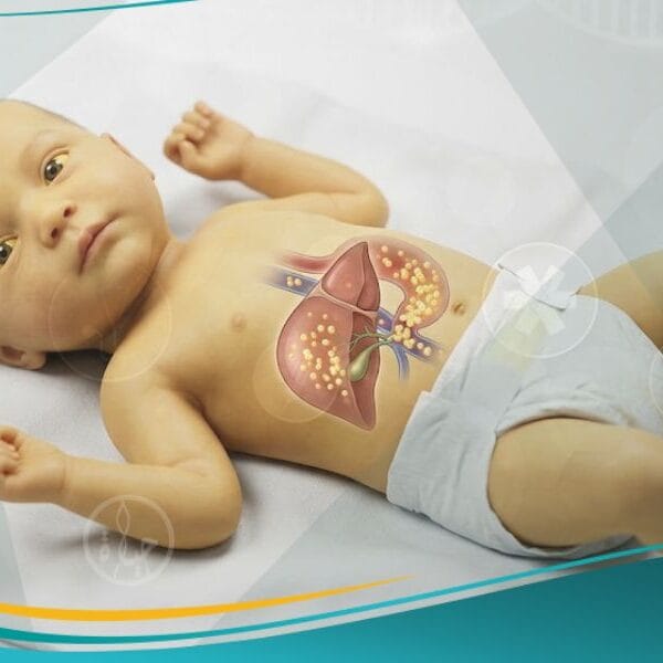 يرقان الرضع