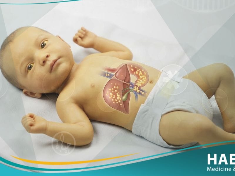 يرقان الرضع