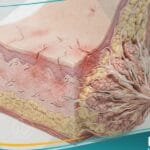 الحلمات المتصدعة