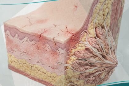 الحلمات المتصدعة