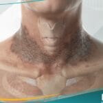 _بلاغرة