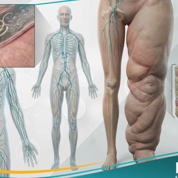 _داء الفيلاريات (2)