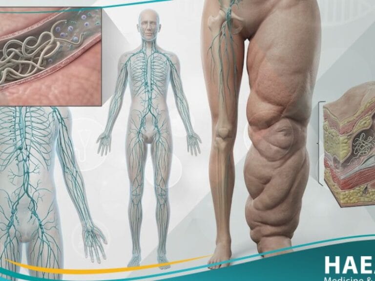 _داء الفيلاريات (2)