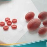 فقر الدم الضخم الأرومات