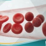 كثرة الكريات الحمر الكروية الخلقي