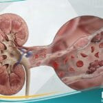 متلازمة انحلال الدم-اليوريمية
