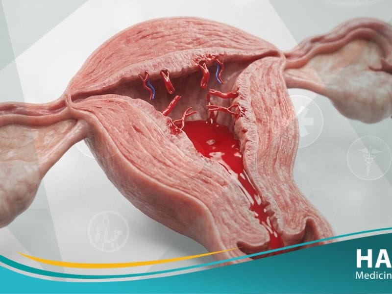 _نزيف ما بعد الولادة