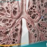 _ورام عضلي في الأوعية اللمفاوية والدموية (1)