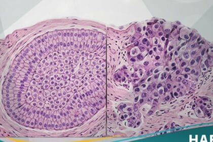 الاورام الحميدة والخبيثة