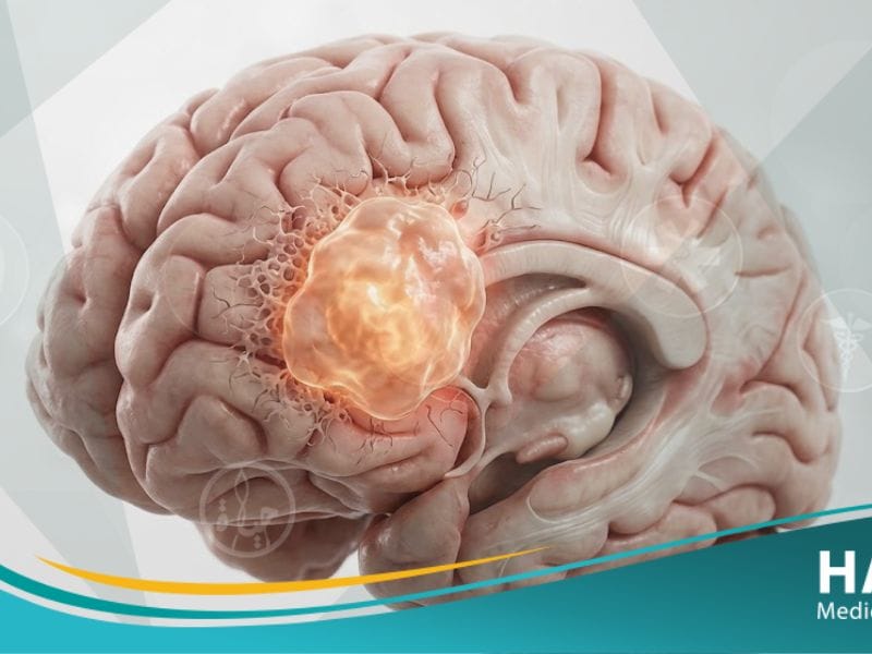 الورم الدبقي | 5 حقائق عن الأسباب، الأعراض، والتشخيص 19 _الورم الدبقي