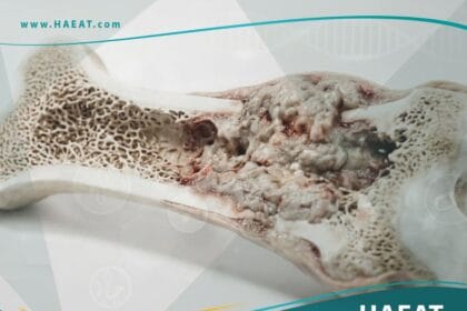 ساركوما العظام