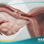 سرطان قناة فالوب (2)