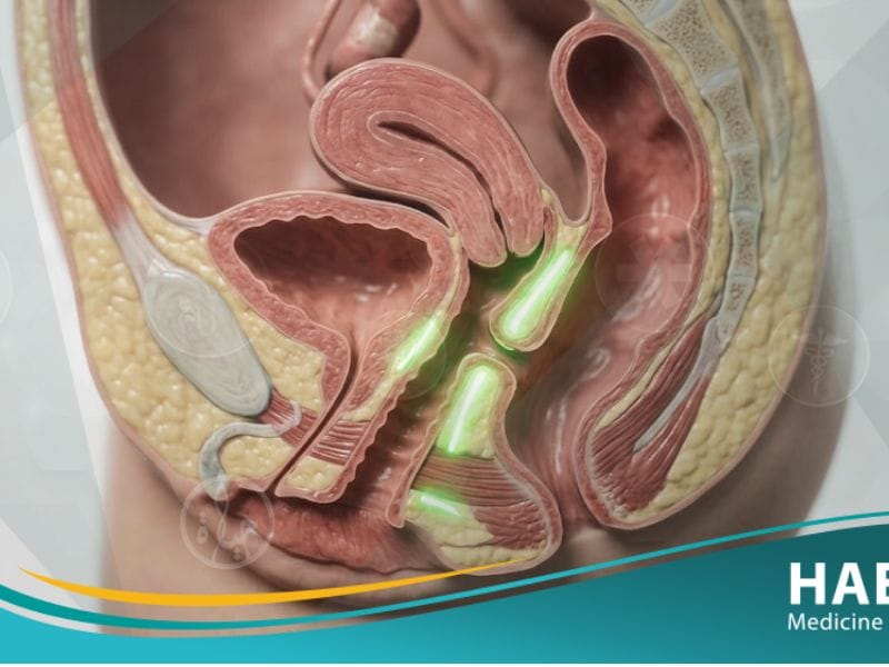ناسور مهبلي | 5 حقائق عن الأعراض، الأسباب، والعلاج 19 ناسور مهبلي (3)