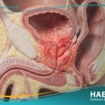 التهاب البروستاتا المزمن (1)