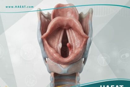 عقيدات وأورام الحنجرة الحميدة