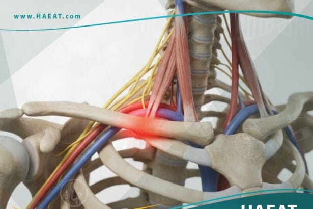 متلازمة مخرج الصدر (1)