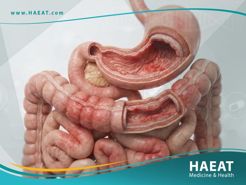 التهاب المعدة والأمعاء | 9 حقائق، الأسباب، وعوامل الخطر 19 _التهاب المعدة والأمعاء